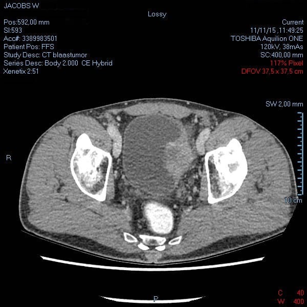 CT-scan 11 november 2015