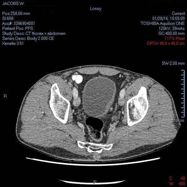 CT-scan 28 januari 2016